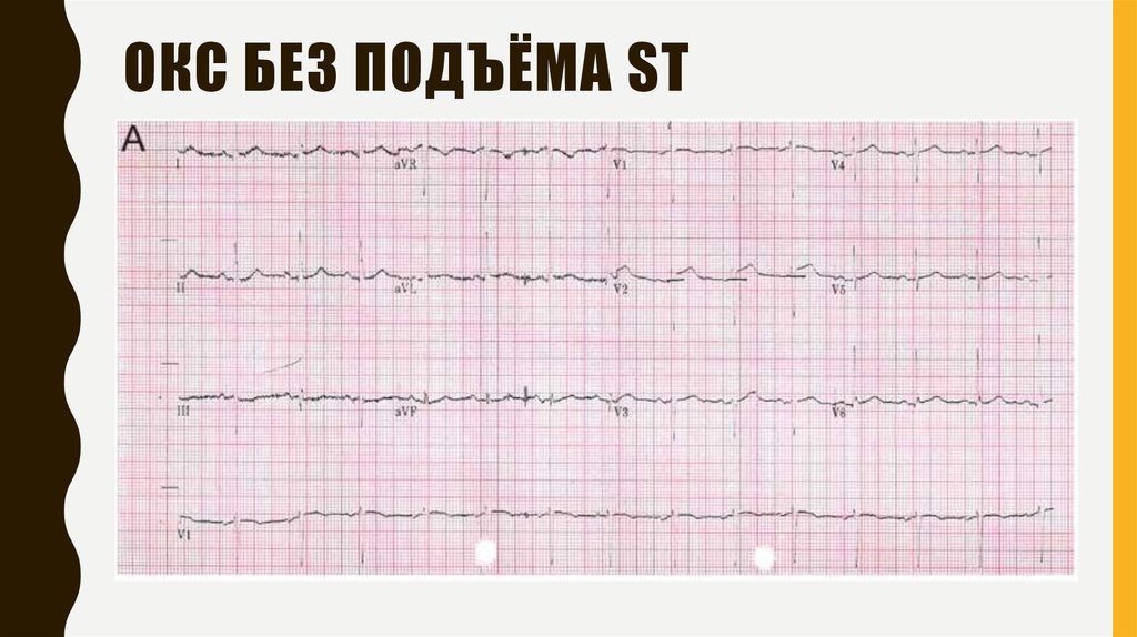 Повреждение миокарда без подъема st. Окс без подъема St. Окс без подъема ст на ЭКГ. Окс с подъёмом St ЭКГ. ЭКГ инфаркт миокарда без подъема St.