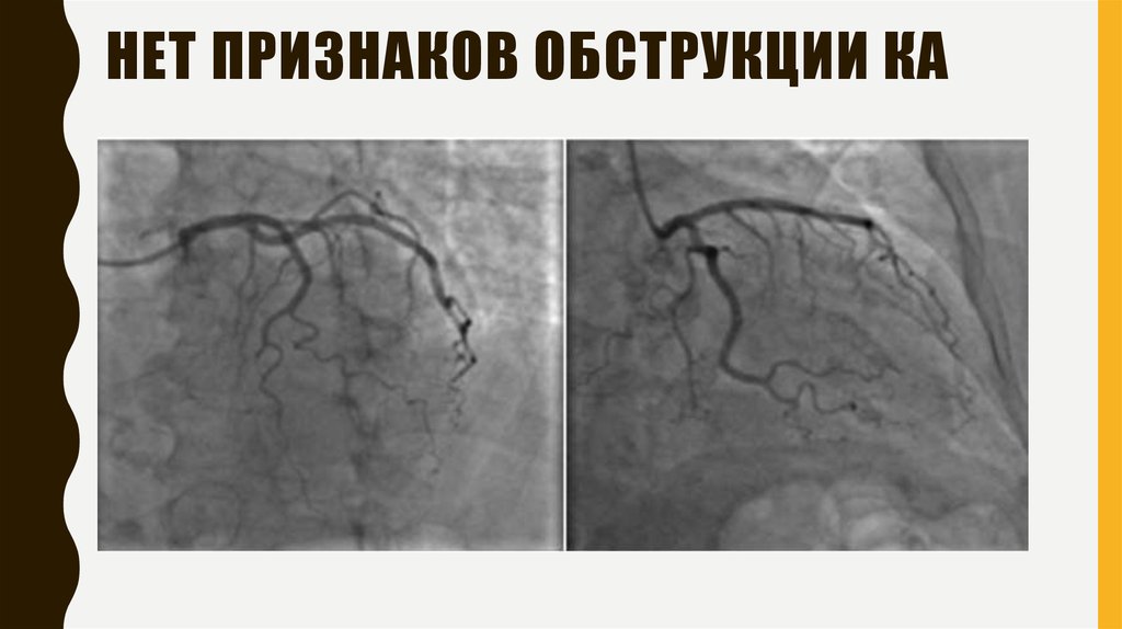 Нет признаков обструкции ка