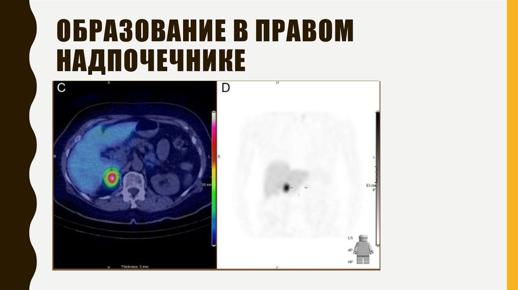 Образование в правом надпочечнике