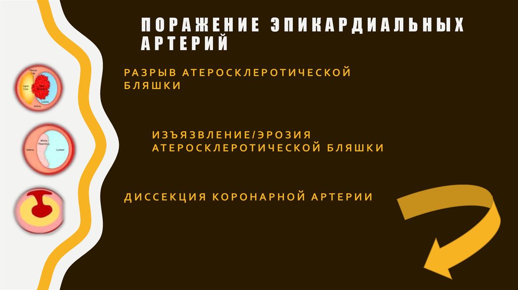 Поражение эпикардиальных артерий