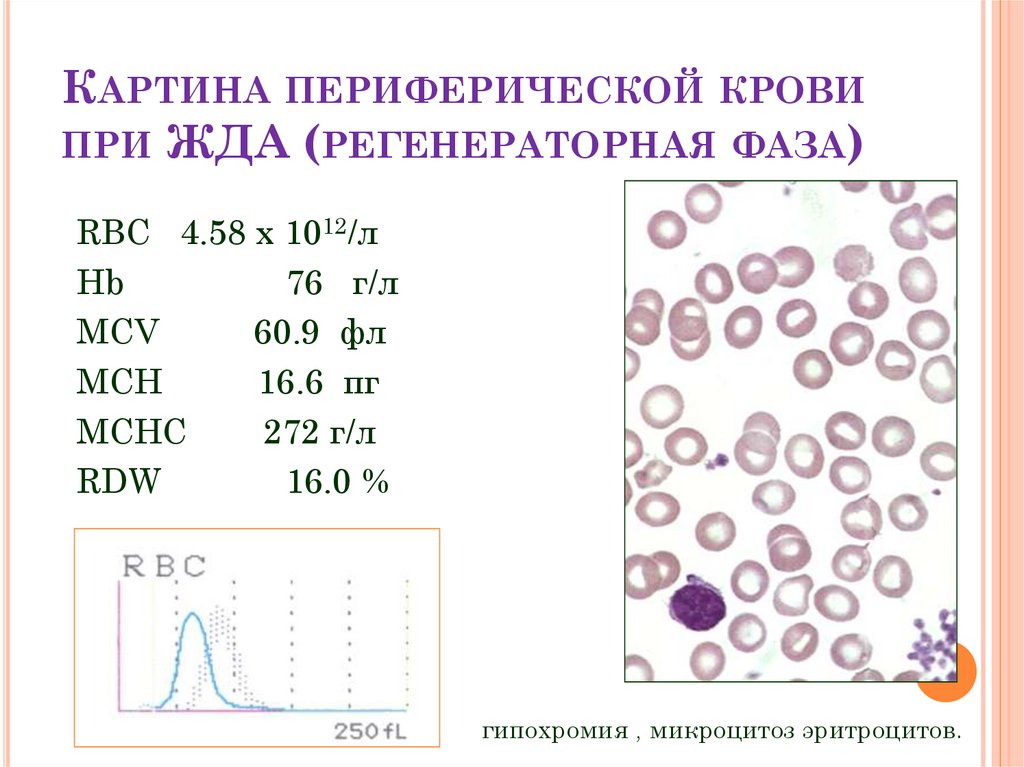 Mch анемия. Морфологическая картина крови при железодефицитной анемии. Картина периферической крови при железодефицитной анемии. Картина периферической крови при апластической анемии. Изменения периферической крови при железодефицитной анемии.