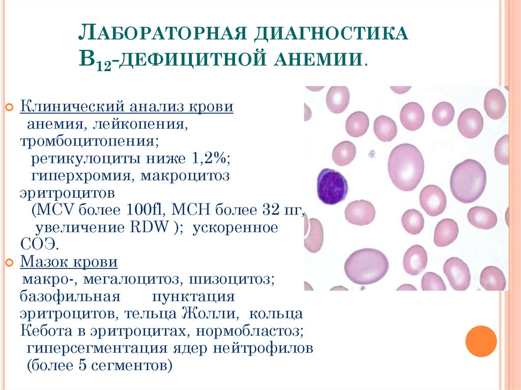 Анемия в моче. Лабораторные исследования при б12 дефицитной анемии. Ретикулоциты при в12 дефицитной анемии. Б12 дефицитная анемия анализ крови показатели. В12 анемия клинический анализ крови.