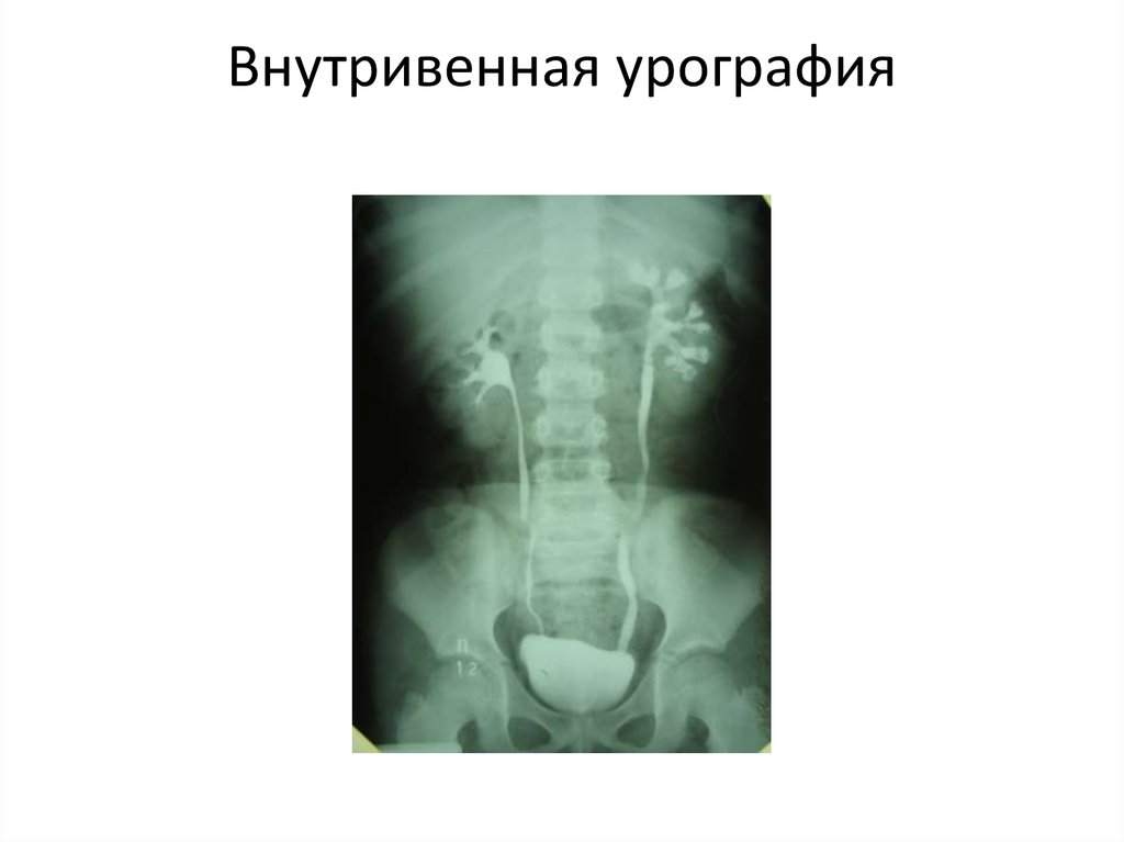 Внутривенная урография