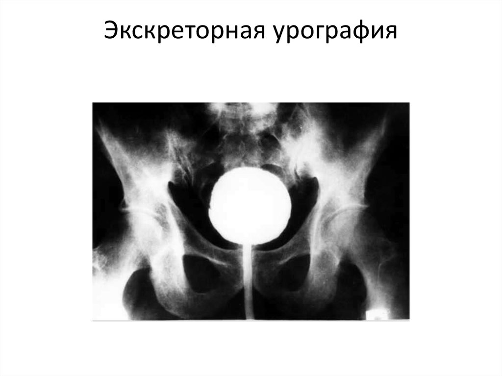 Экскреторная урография