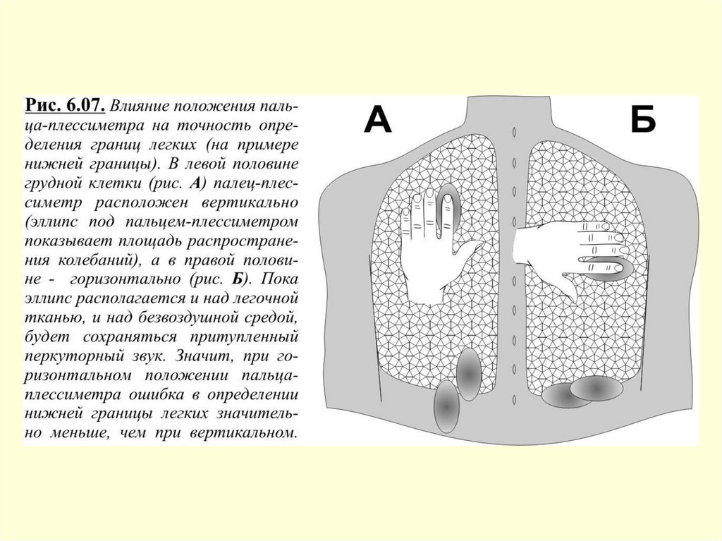 Границы легких в норме при перкуссии. Моренгеймова ямка перкуссия легких. Исследование нижней границы легкого схема. Корни легких перкуссия. Два примера лёгких способ.