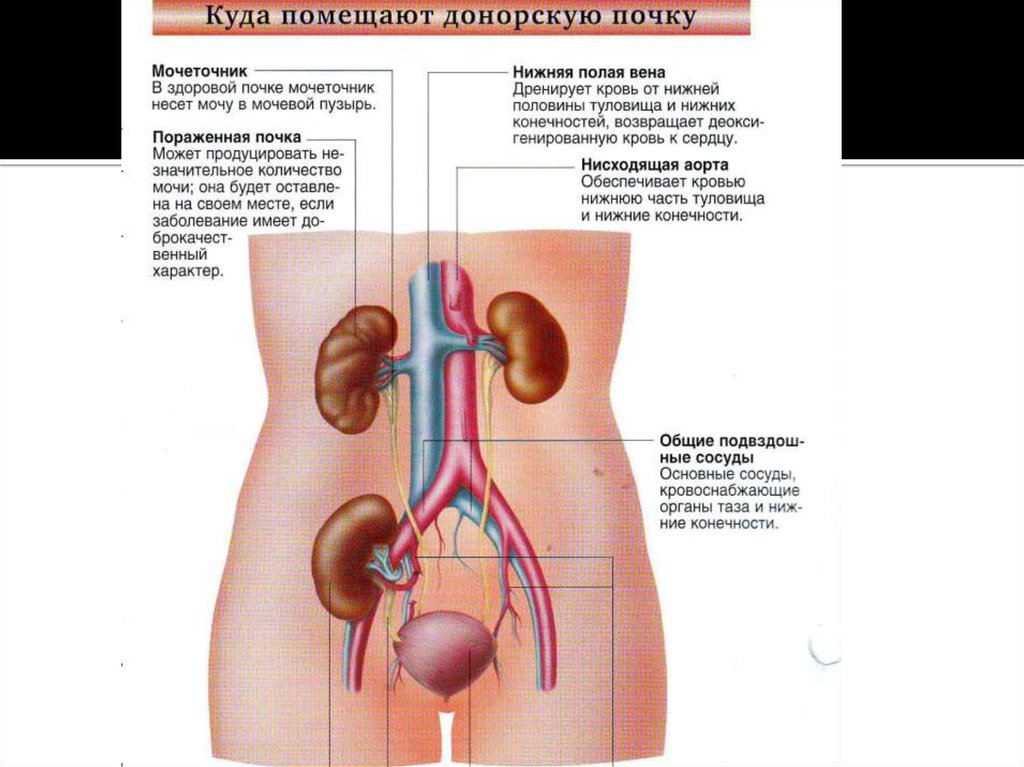 Сколько почек. Трансплантация почки схема. Почка человека трансплантация. Понятие о трансплантации почки.
