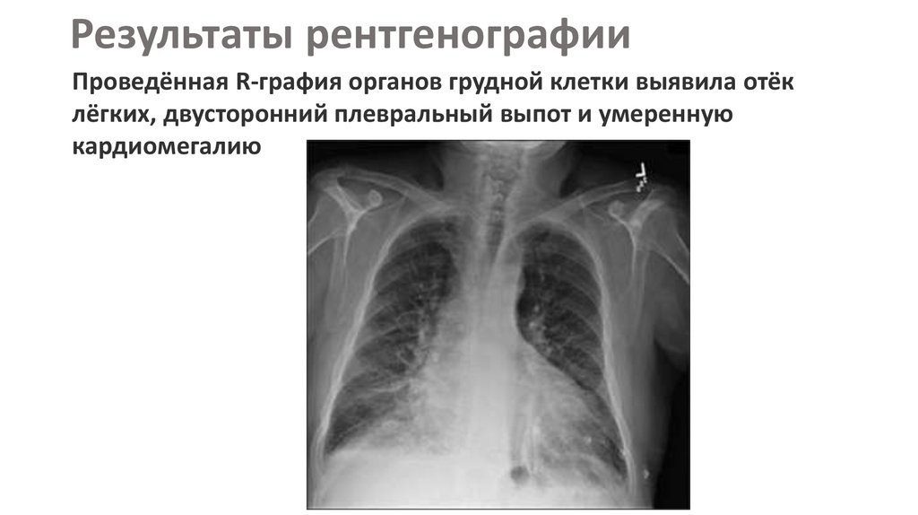 Результаты рентгена. Результаты рентгенографии. Кардиомегалия на рентгенограмме легких. Результат рентгеновских снимков. Результат рентгена легких.