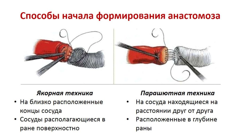 Сосудистый шов методы наложения. Методика наложения сосудистого шва. Сосудистый шов Парашютная техника. Критерии сосудистого шва. Парашютная техника наложения сосудистого шва.