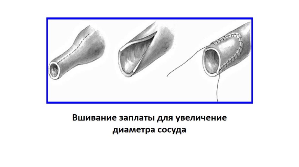 Диаметр сосудов