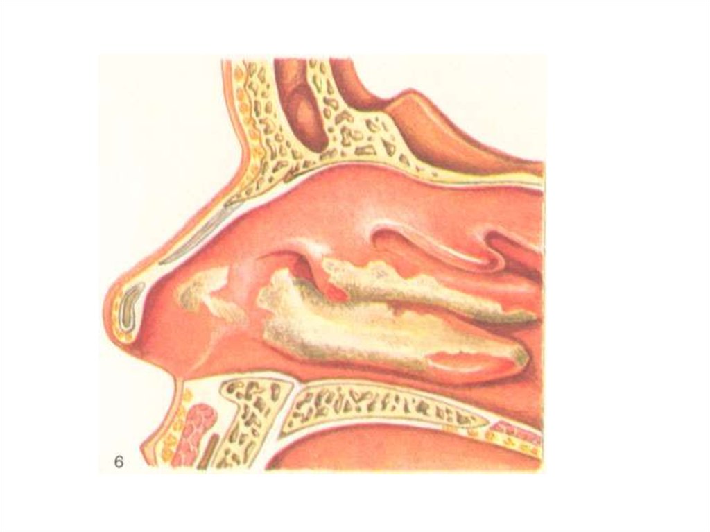 Слизистая оболочка уха. Дифтерия верхних дыхательных путей. Локализованная дифтерия носоглотки.