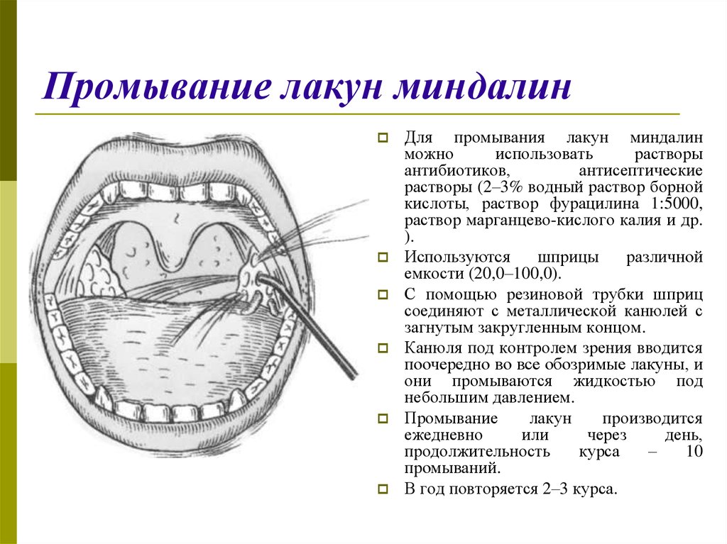 Полость готовиться. Схема промывания миндалин шприцом. Промывание миндалин алгоритм. Тонзиллит промывание лакун.