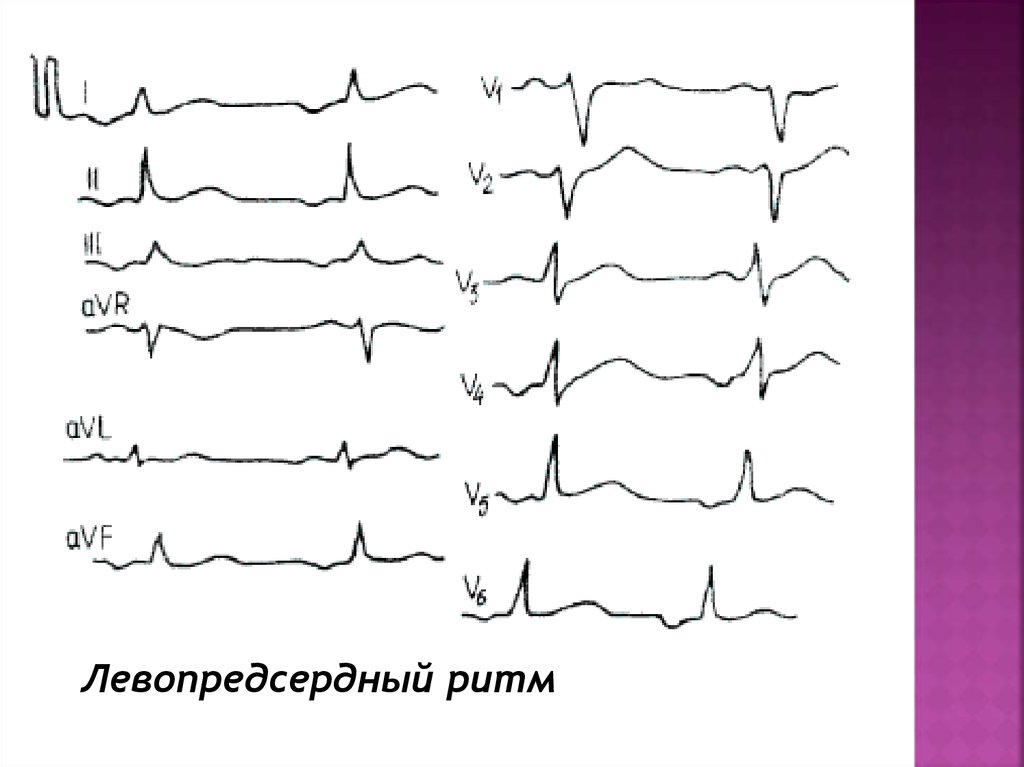Предсердный ритм. Левопредсердный ритм на ЭКГ. Левопредсердный эктопический ритм. Нижний левопредсердный ритм на ЭКГ. Левопредсердный ритм признаки на ЭКГ.