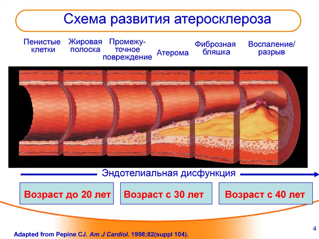 2 стадия атеросклероза