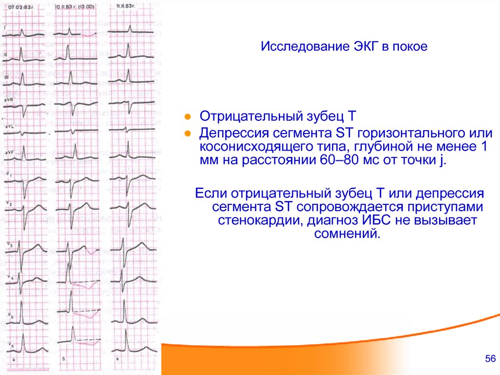 Высокий т на экг причины. ЭКГ отрицательный зубец т в v1-v3. Отрицательный зубец р на ЭКГ В v1. Отрицательный зубец т в v1 v2. Отрицательный зубец r во 2 отведении.