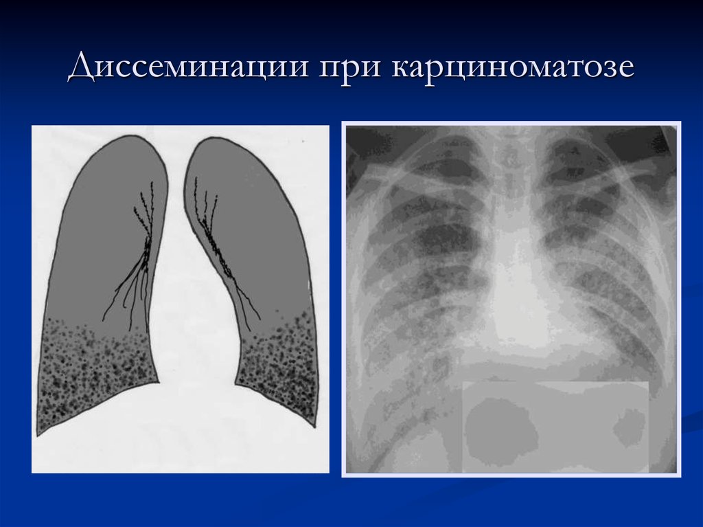 Диффузный рак легких. Милиарный диссеминированный туберкулез рентген. Диссеминированный туберкулёз лёгких рентген. Диссеминированный туберкулез на кт.