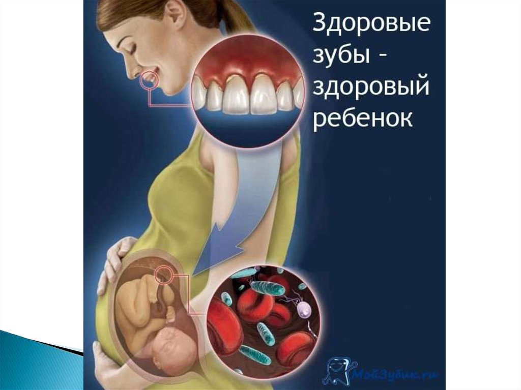 Полости рта беременности. Беременные и зубы. Профилактика кариеса зубов у беременных. Профилактика стомат заболеваний у беременных.