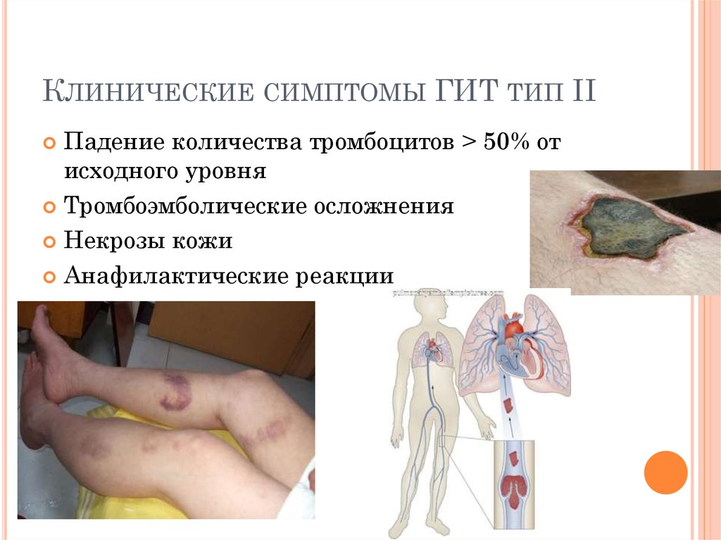 Клинические симптомы ГИТ тип II