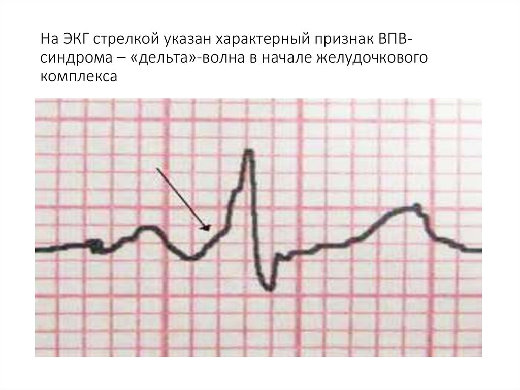 Проводимость в сердце, её замедление, нарушение: причины, локализации ...
