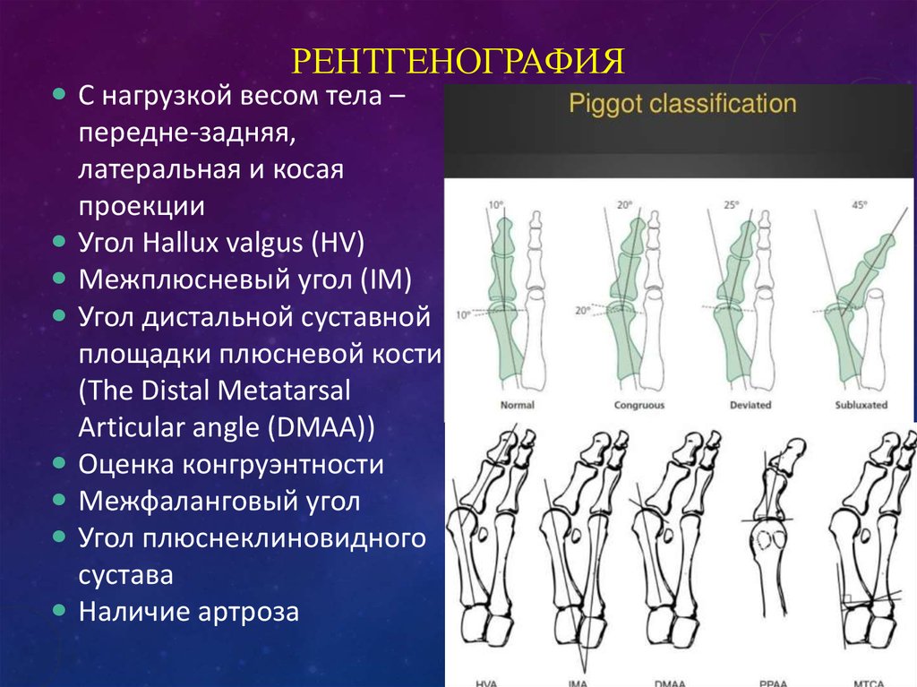 Дистальный межфаланговый сустав