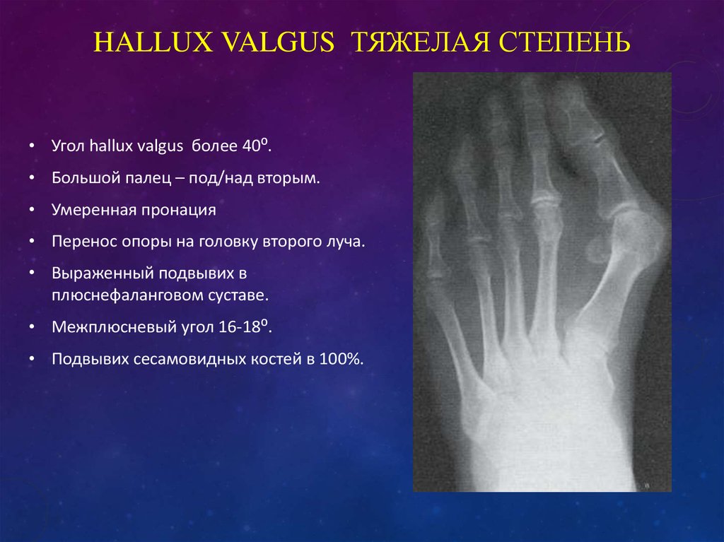 Деформация пальцев стопы мкб. Вальгусная деформация стопы hallux valgus. Вальгусная деформация большого пальца стопы рентген. Рентгенография вальгусная деформация стопы.