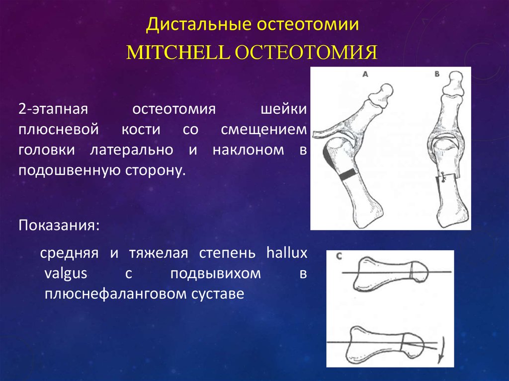 Остеотомия. Остеотомия презентация. Дистальная остеотомия. Остеотомия 2 плюсневой кости.