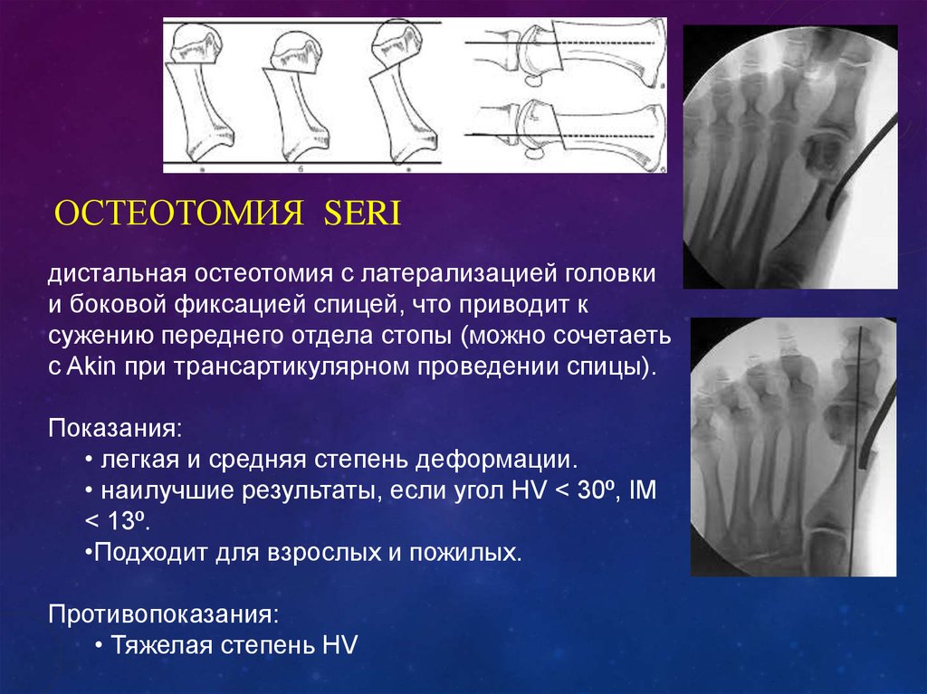 Остеотомия. Этапы операции остеотомии.