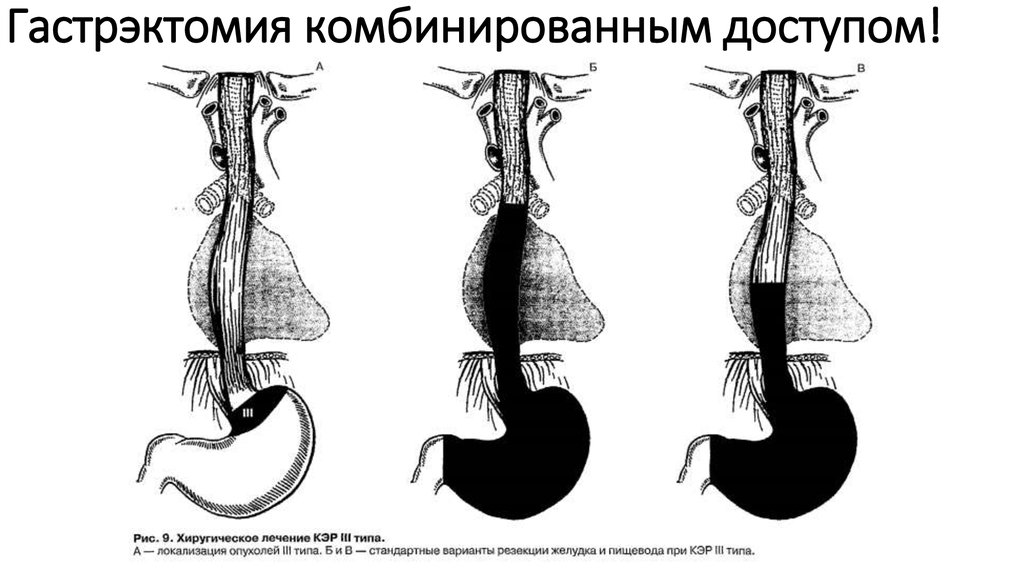 Гастрэктомия по сигалу схема