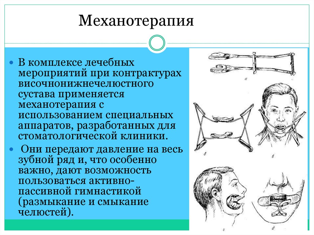 Контрактура нижней. Аппараты для механотерапии при контрактурах челюсти. Механотерапия при контрактуре. Механотерапия челюсти. Механотерапия в стоматологии.