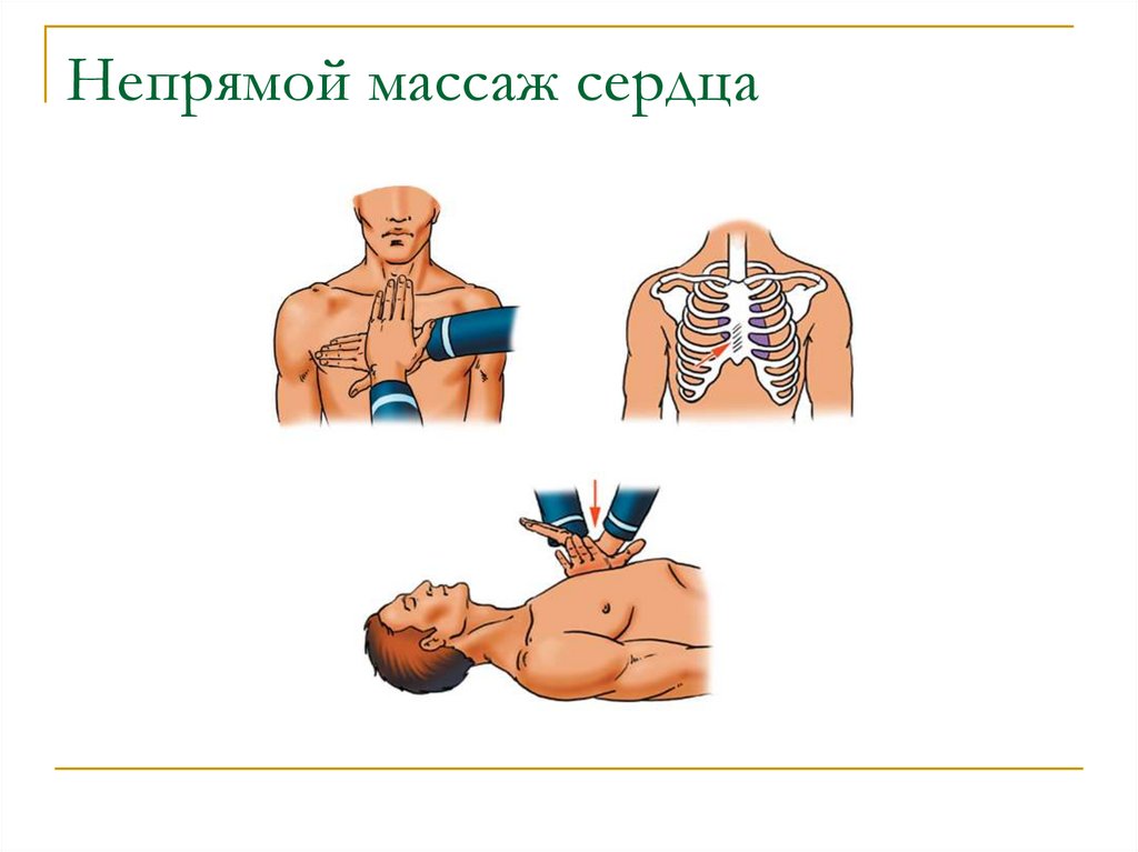 Непрямой сердца. Непрямой массаж сердца техника. Расположение рук при непрямом массаже сердца. Непрямой массаж сердца (НМС). Закрытый массаж сердца.