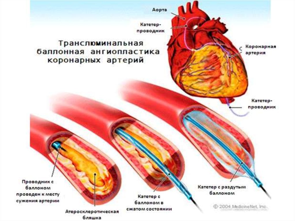 Ангиопластика. ТРАНСЛЮМИНАЛЬНАЯ баллонная ангиопластика. Баллонная ангиопластика при ИБС. Лазерная коронарная ангиопластика. Лазерная ангиопластика сосудов сердца.