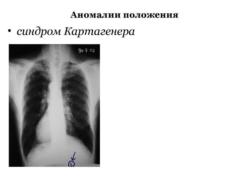 Синдром картагенера презентация