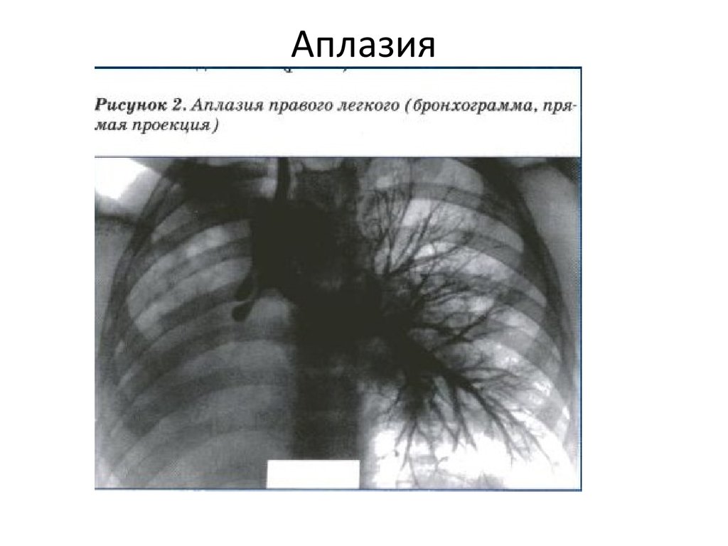 Отсутствие легочного рисунка на рентгене