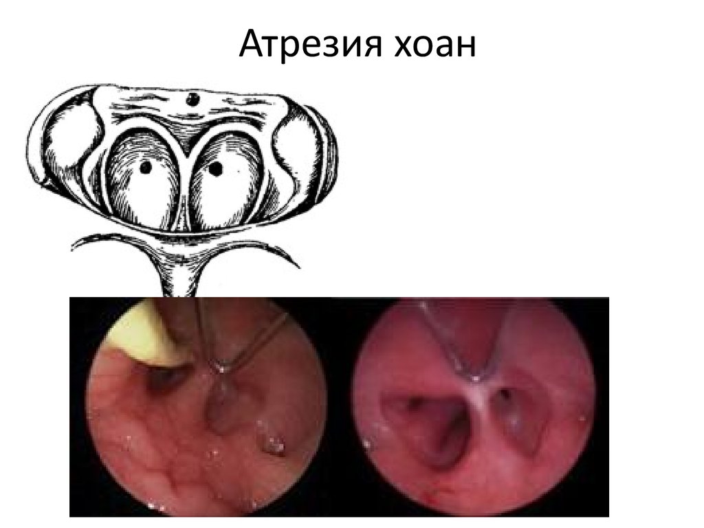 Атрезия хоан