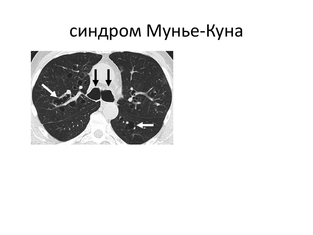 Кт бронхов. Трахеобронхомегалия (синдром Мунье куна). Трахеобронхомегалия кт. Клинические признаки синдрома Мунье куна.