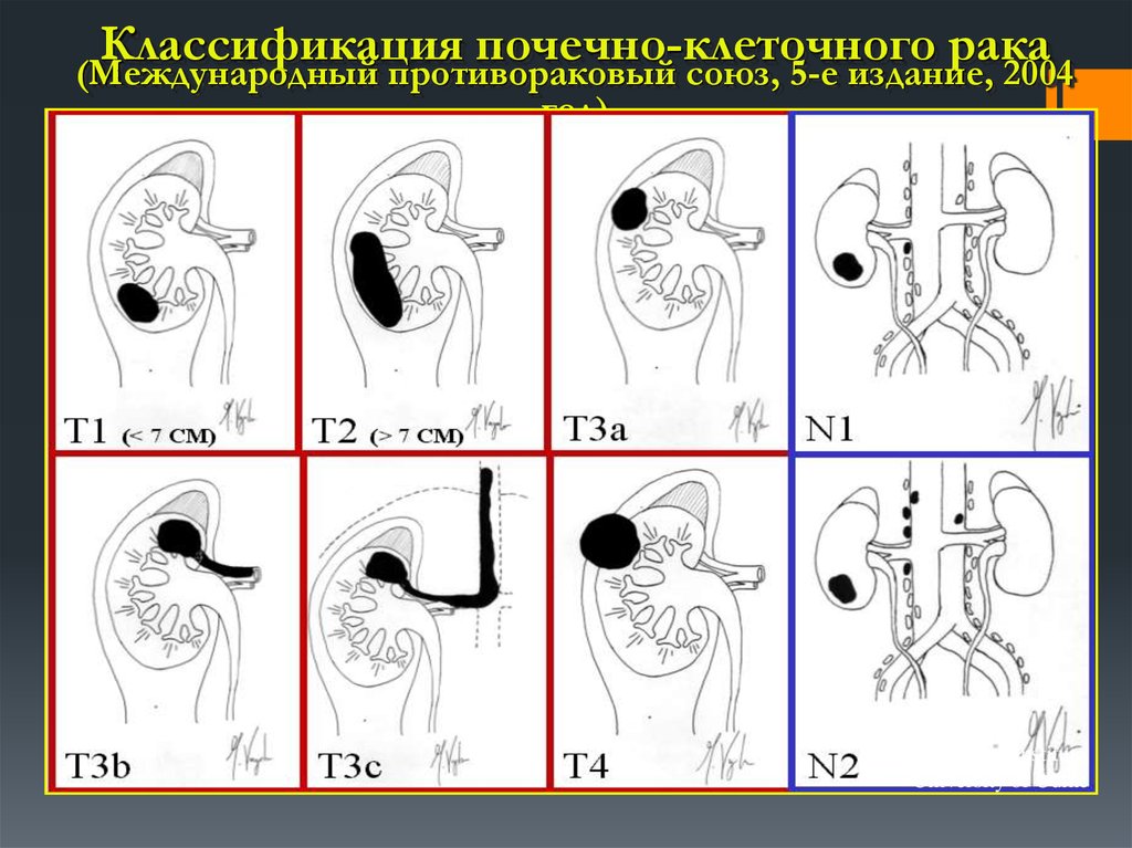 Классификация почек