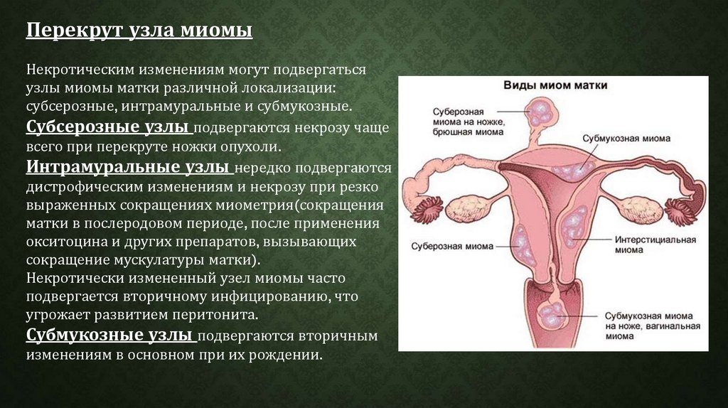 Презентация по гинекологии миома матки