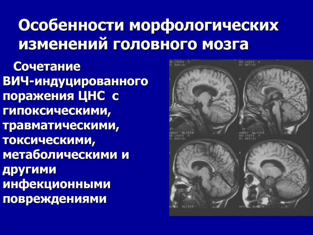 Возрастные изменения головного мозга