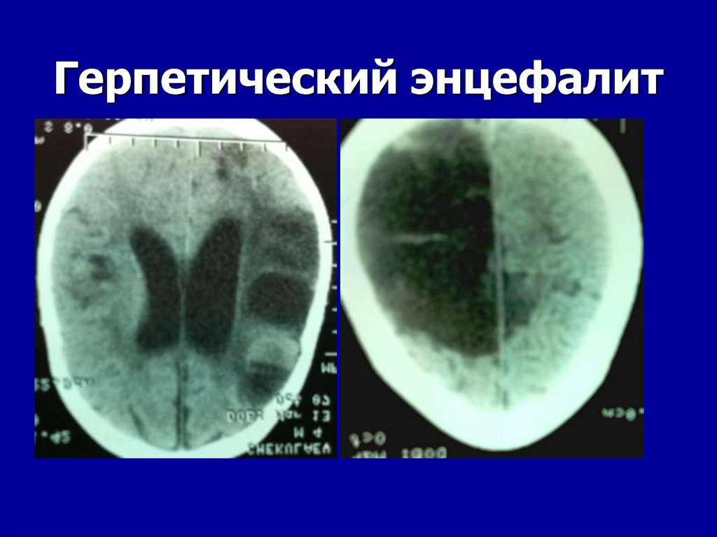 Энцефалит головного мозга у взрослых. Герпетический энцефалит кт головного мозга. Острый герпетический менингоэнцефалит. Герпетический энцефалит головного мозга симптомы.