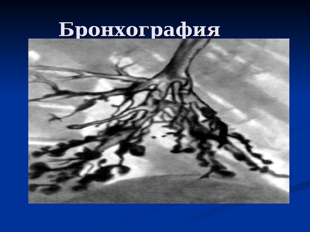 Бронхография. Бронхография презентация. Бронхография органов дыхания.