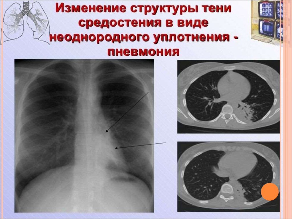 Лучевая диагностика органов средостения презентация