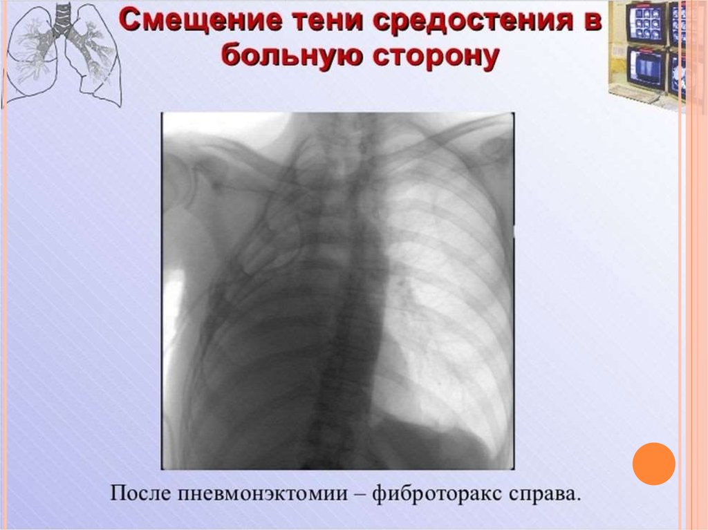 Лучевая диагностика органов средостения презентация