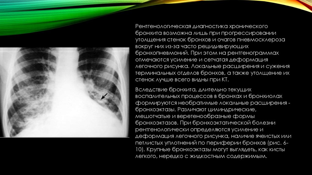 Легочный рисунок рентген. Усиление и деформация легочного рисунка. Легочный рисунок деформирован. Ячеистое усиление легочного рисунка. Легочный рисунок усилен деформирован.