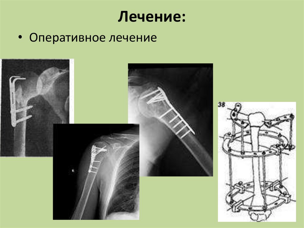 Перелом хирургический левой