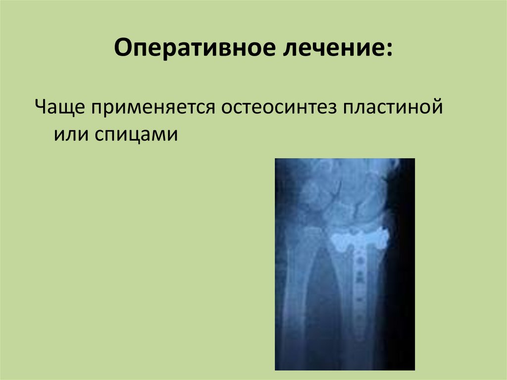 Перелом хирургической шейки плечевой кости остеосинтез. Хирургические переломы шейки плечевой кости остеосинтез спицами. Оперативное лечение перелома костей