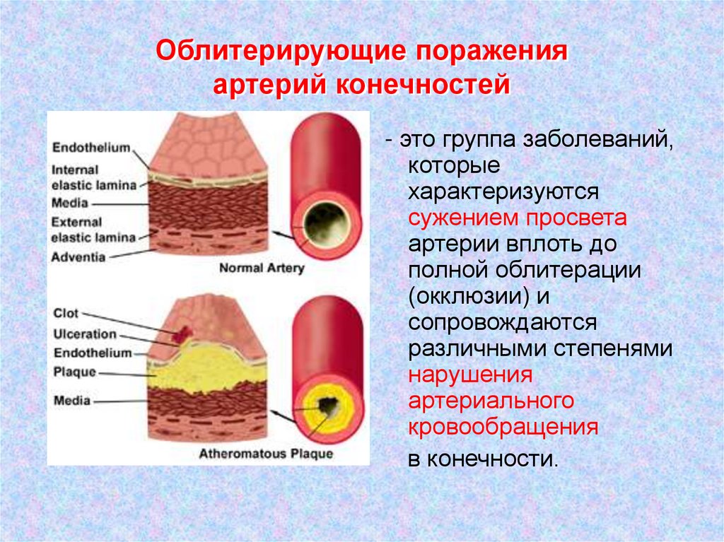 Заболевания артериальных сосудов