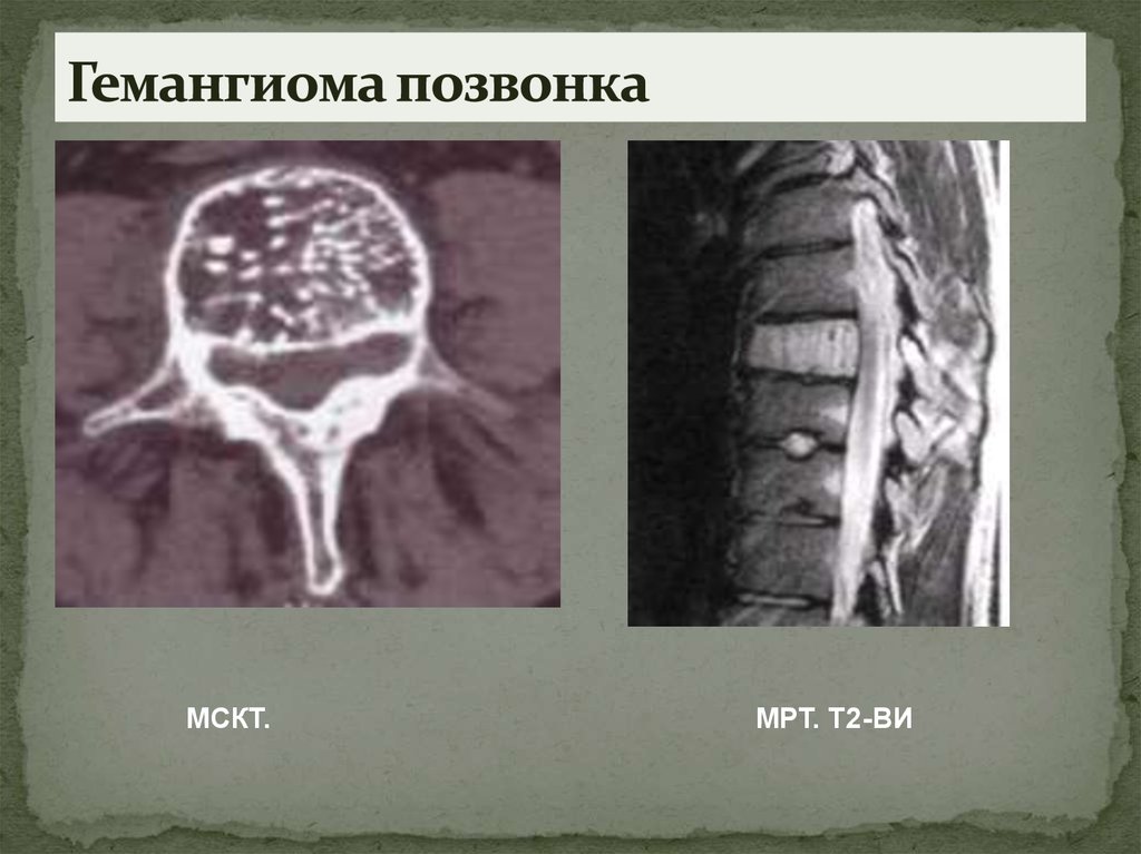 Гемангиома на спине фото