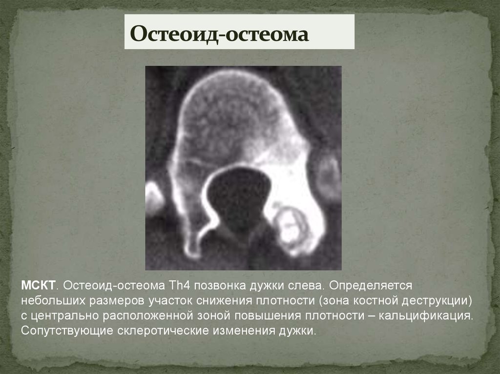 Остеома позвонка. Остеома позвонка рентген. Остеоид остеома позвонка кт. Диагноз остеоид-остеомы устанавливается. Излюбленная локализация остеоид- остеомы.