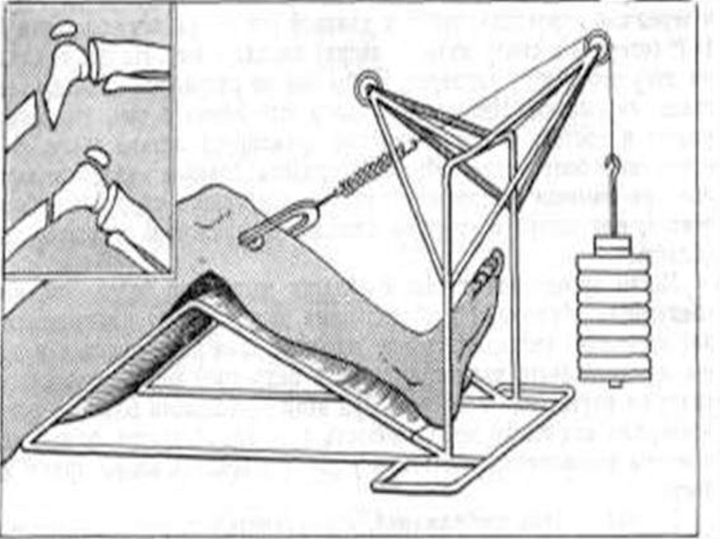 Вытяжение голени. Скелетное вытяжение показания. Консервативные методы лечения переломов. Принципы консервативного лечения переломов. Фиксационный метод лечения переломов.