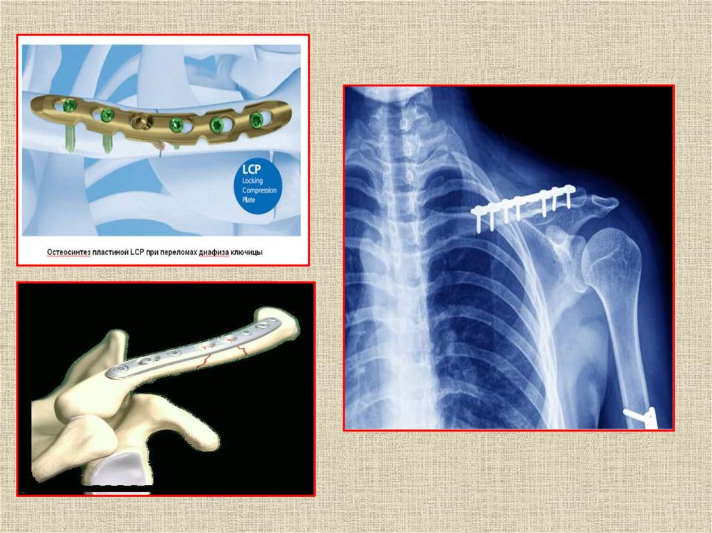 Консервативное лечение вывихов. Лечение переломов и вывихов. Пластина т-образная для шейки плеча. Оперативное лечение переломов. Консервативные методы лечения переломов.