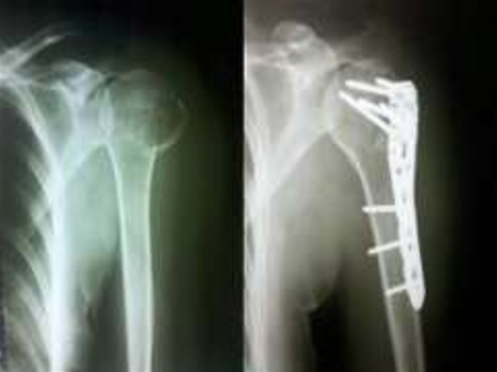 Операция после перелома плеча. Перелом шейки плечевой кости рентген. Остеосинтез шейки плеча рентген. Оскольчатый перелом головки плечевой кости. Вывих с переломом головки и шейки плеча.